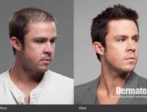 Aging and Hair Loss