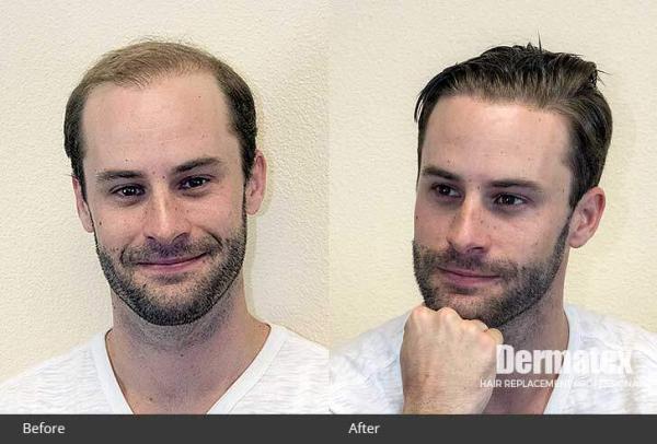 mens non-surgical hair replacement orange county california